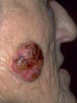Plaveiselcelcarcinoom (Squamous Cell Carcinoma)