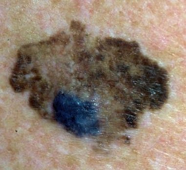 Melanoom: oppervlakkig verspreidend melanoom (superficial spreading melanoom (SSM)