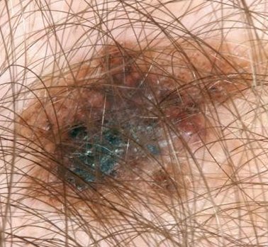 Melanoom: oppervlakkig verspreidend melanoom (superficial spreading melanoom (SSM)