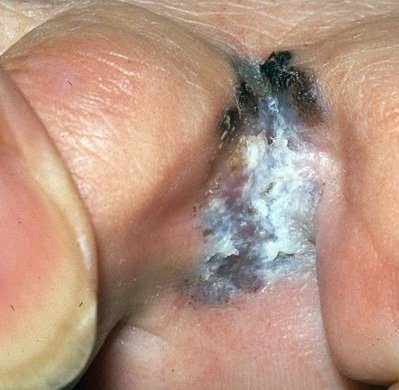 Melanoom: acrolentigineus melanoom (ALM)