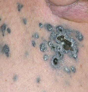 Huidmetastasen van een melanoom (satelliet)