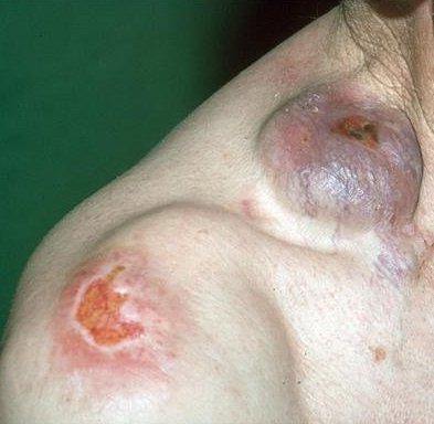 Huidmetastasen van een melanoom (satelliet)