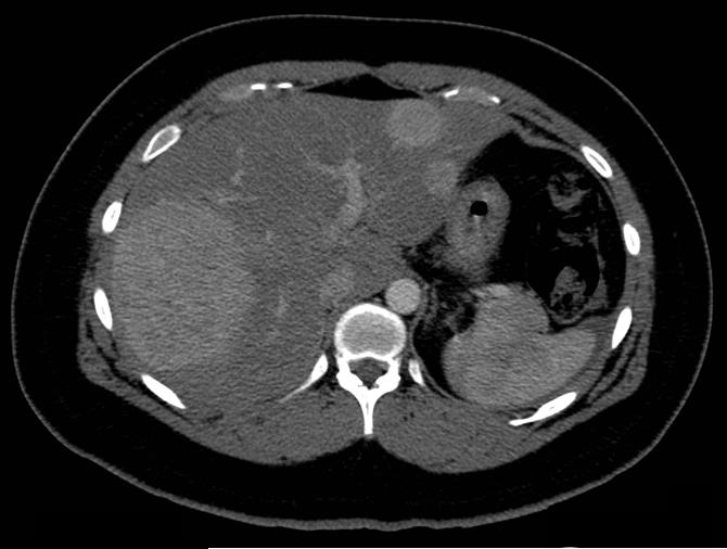 CT-abdomen: leveradenoom