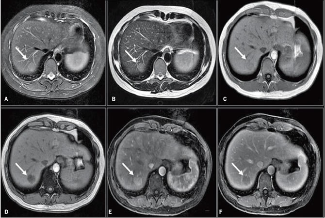 MRI: leveradenoom